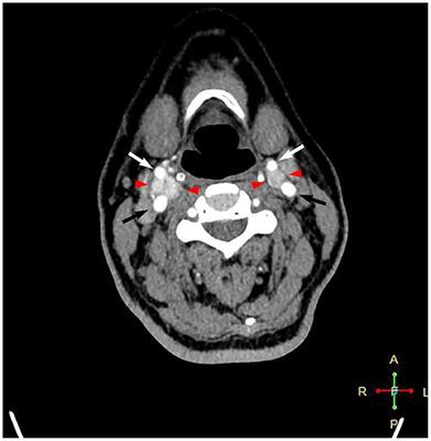 Case report: Cardiac arrest during carotid body tumor resection indicating carotid sinus hypersensitivity